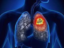 Hội chứng chèn ép tĩnh mạch chủ trên thường gặp ở ung thư phổi